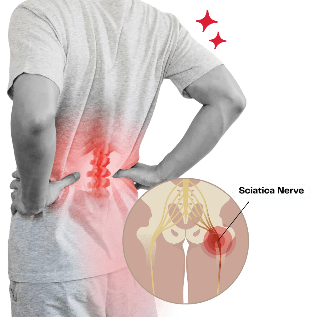 Lo Physio Sciatica 3