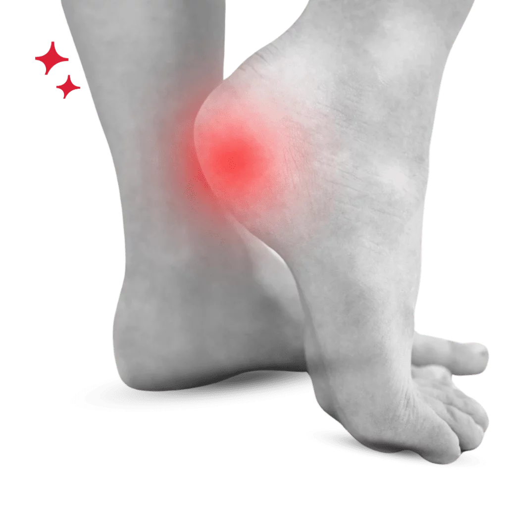 Lo physio plantar fasciitis