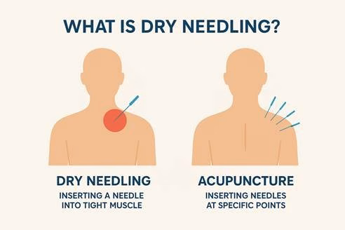difference between dry needling and acupuncture